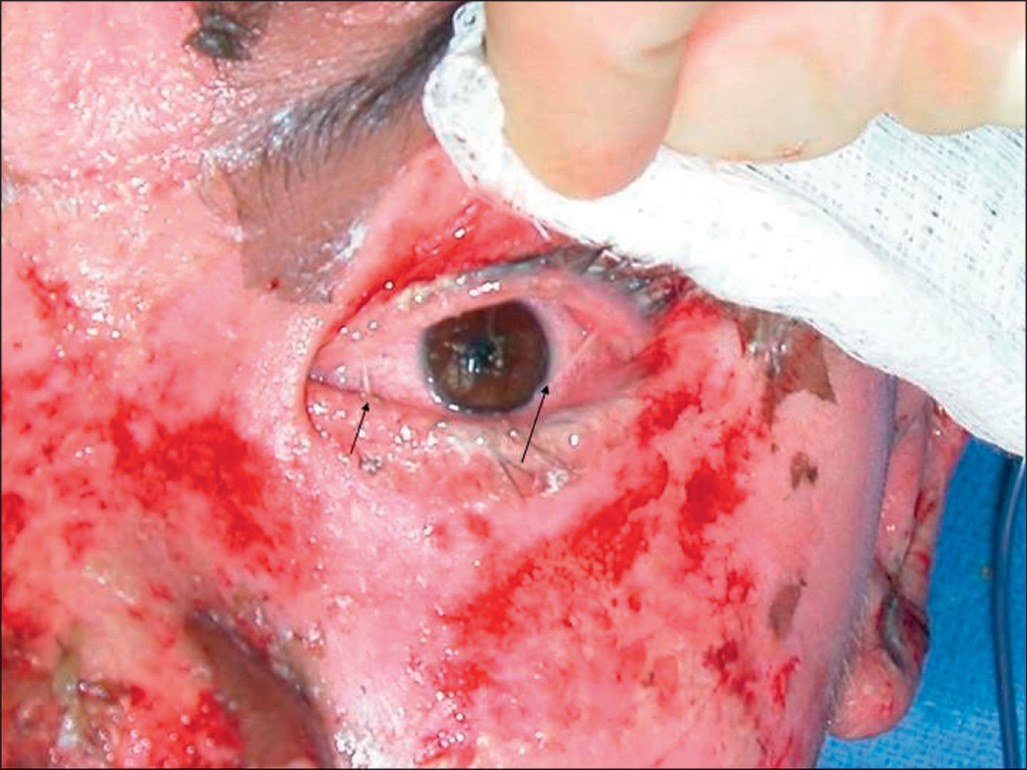 A photograph shows exposed periocular skin loss with a raw mucocutaneous surface around the eye, with sutures at the eyelid margin securing the tissues.