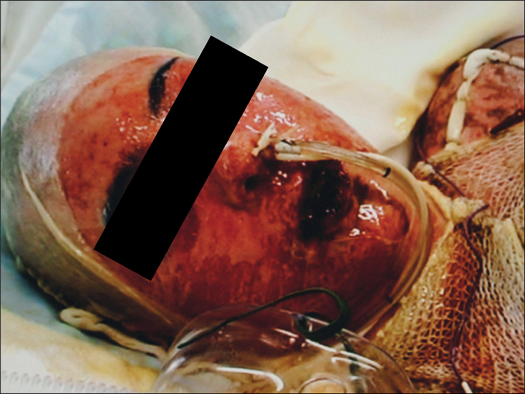 A photograph shows a patient with widespread mucosal and cutaneous sloughing. The facial and cervical skin show large areas of detached epidermis and raw, moist tissue.