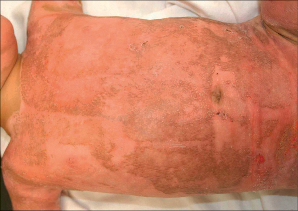 A photograph shows a patch of homograft covering previously burned skin on the chest and upper abdomen; the graft surface displays uneven patchy areas producing an irregular textured appearance.