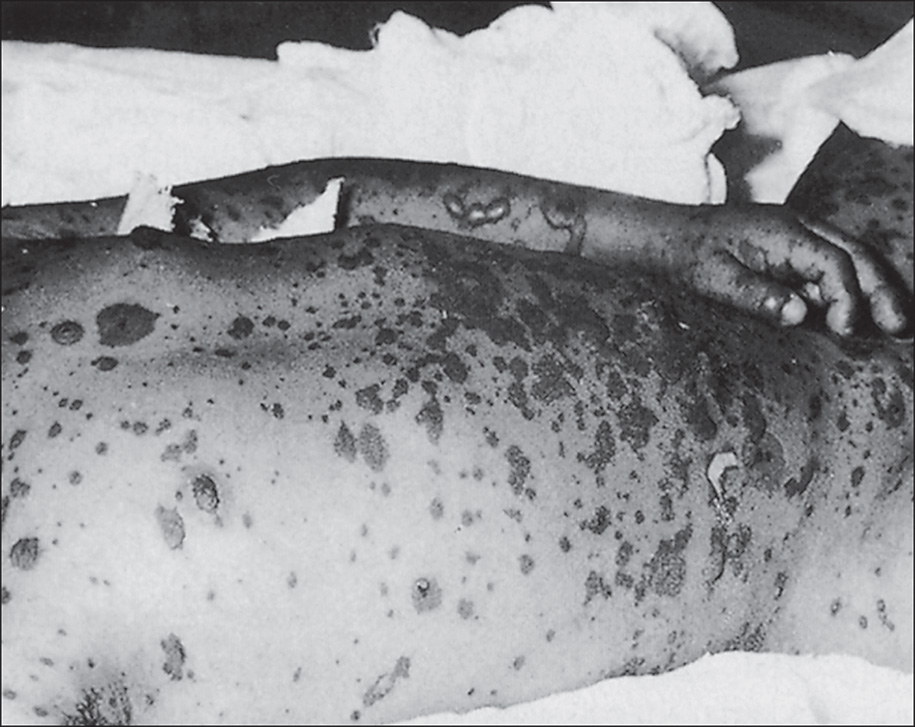 A light and dark photograph shows tender skin with soft blisters and peeling areas on the trunk and arm. The top layer of skin is coming off in thin sheets, leaving the raw skin underneath exposed.