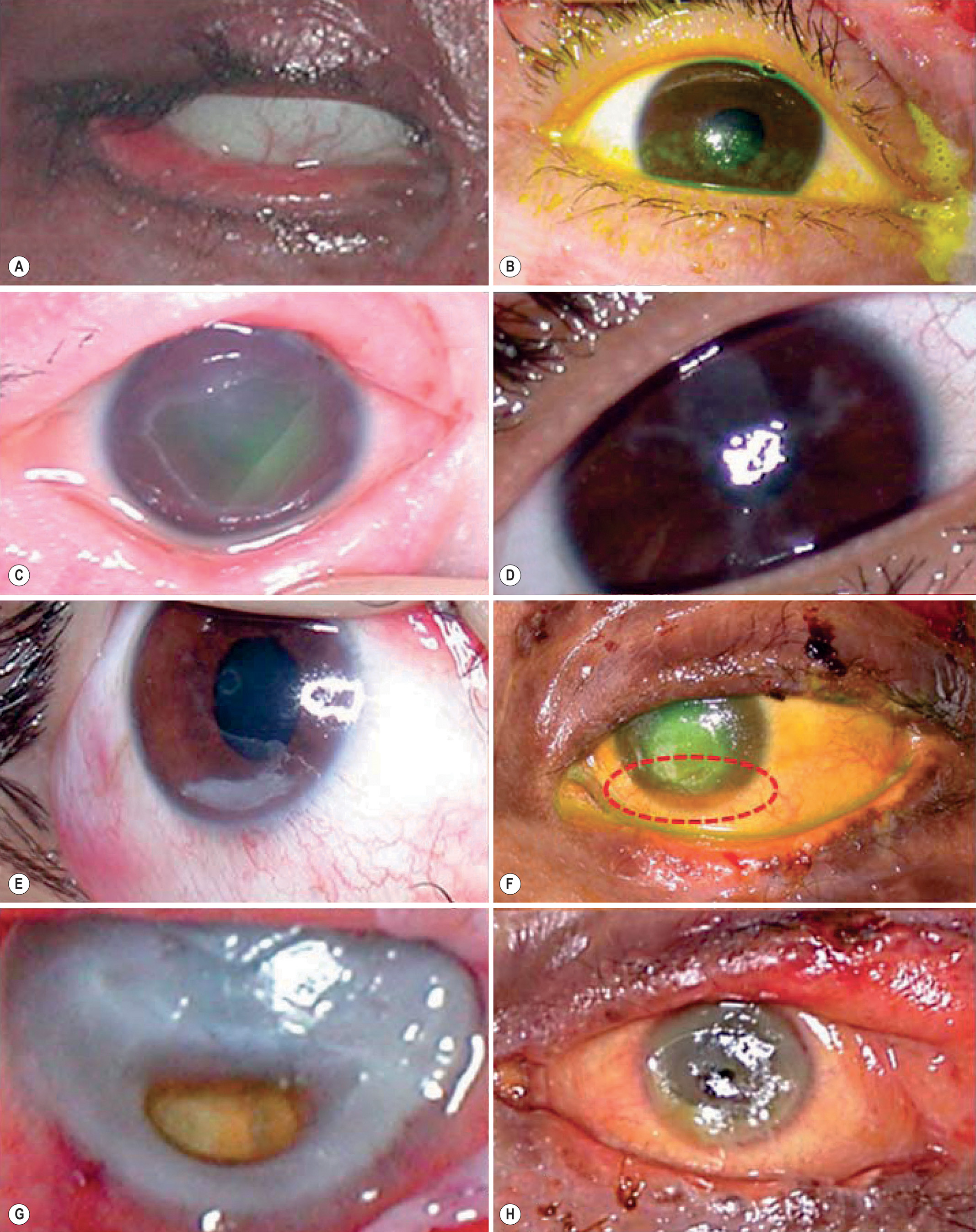 A set of eight photographs showing different eye surface injuries after burns, including eyelid deformities, ulcers, and corneal damage. A set of eight close-up eye photographs labeled A to H, arranged in rows, shows multiple ocular surface complications seen after burns. Part A shows lagophthalmos with eyelid scarring and incomplete closure, leaving the eye partially exposed. Part B shows exposure keratopathy, where the corneal surface appears dry and irregular due to poor lid coverage. Part C shows an epithelial defect with a dull, uneven corneal surface, indicating loss of the outer layer. Part D shows herpetic keratitis with patchy opacity and surface irregularity. Part E shows a corneal ulcer with deep surface depression and thinning of the central cornea. Part F shows the same condition complicated by hypopyon, seen as a fluid layering in the anterior chamber. Part G shows a descemetocele with extreme corneal thinning and bulging outward at the center. Part H shows corneal perforation with fluid leakage and collapse of the anterior surface.