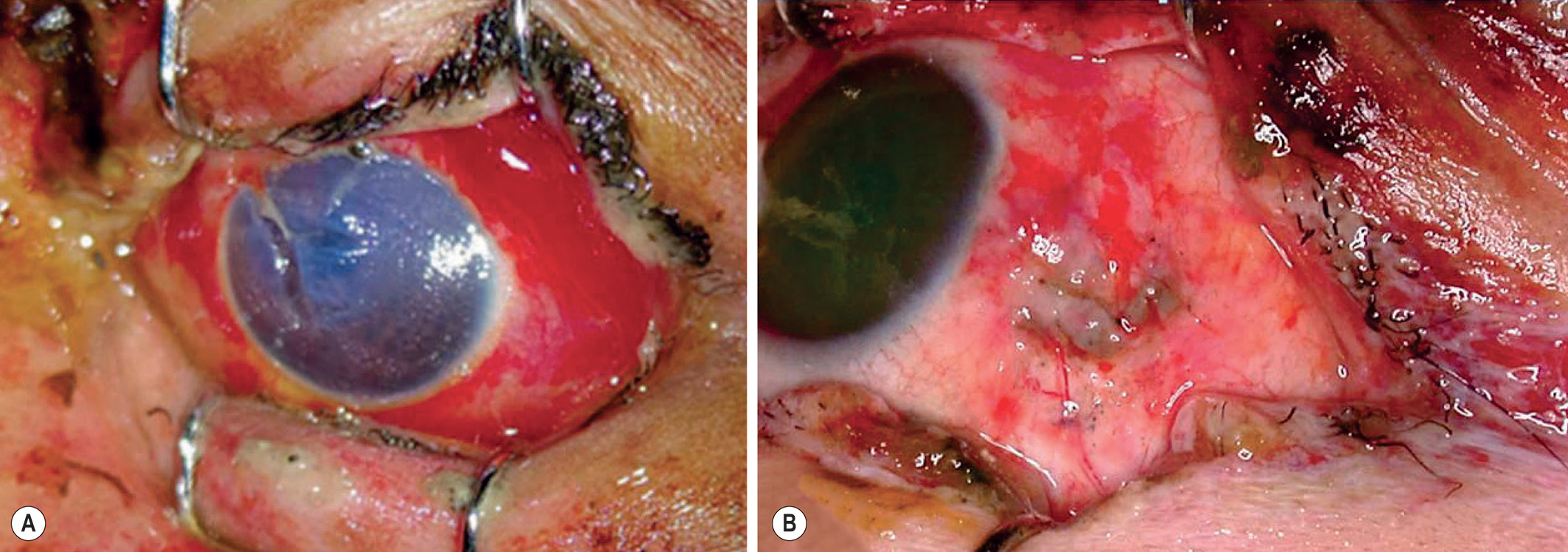 A two-part photograph shows tears of the cornea and sclera with surrounding swelling and surgical repair markings. The two photographs labeled A and B illustrate open-globe injuries resulting from trauma. Part A shows a large vertical split across the corneal surface exposing the deeper layers of the eye, while Part B shows a scleral tear with visible sutures along the white of the eye and attached conjunctiva.