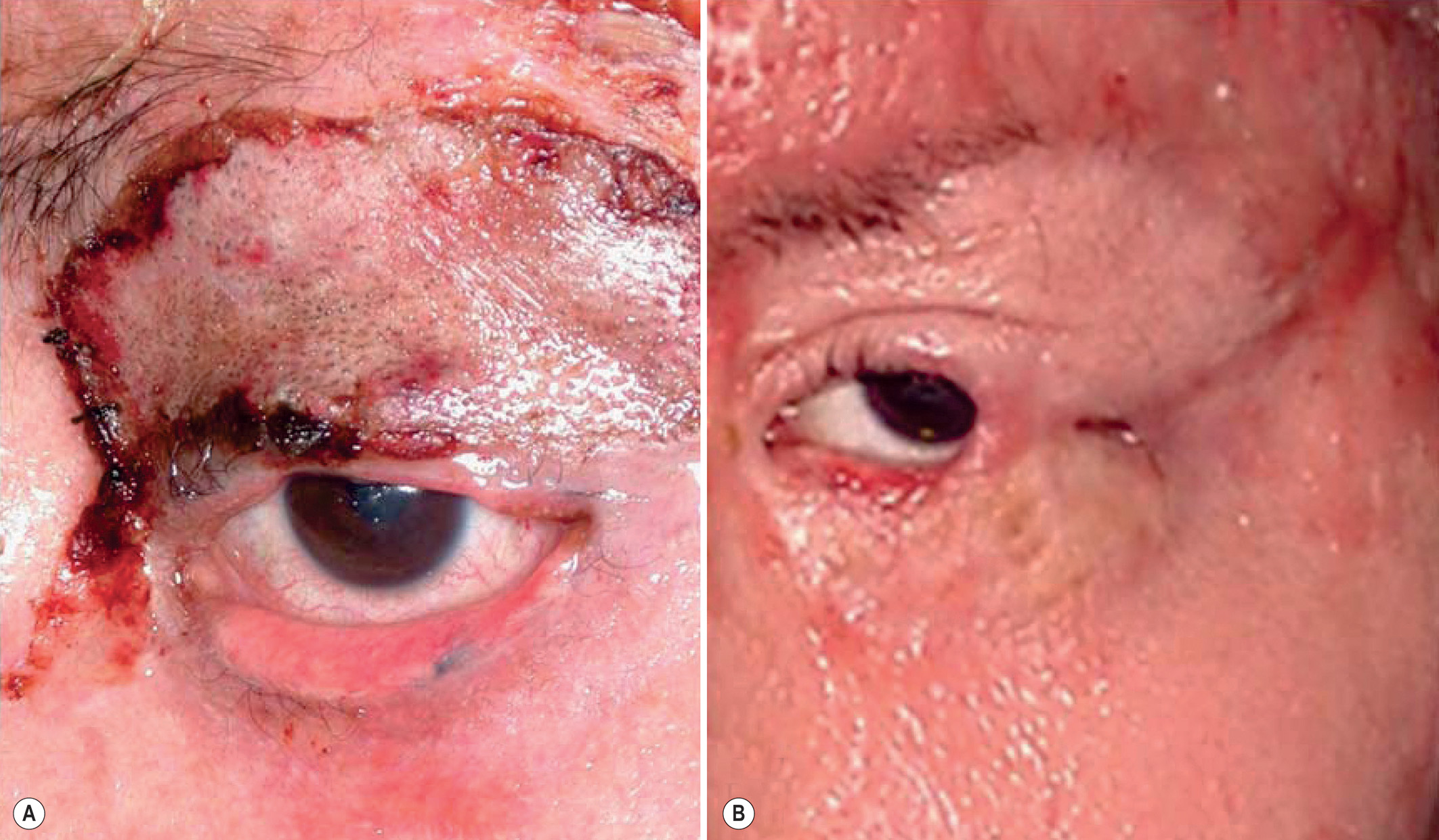 A two-part photograph shows a burned upper eyelid before and after surgical release and grafting to restore lid mobility. The two-part photograph labeled A and B. Part A shows a contracted upper eyelid with a tight scar band preventing full closure. Part B is the photo taken after surgery, showing the eyelid relaxed and repositioned following skin grafting and lateral tarsorrhaphy closure at the outer corner of the eye.
