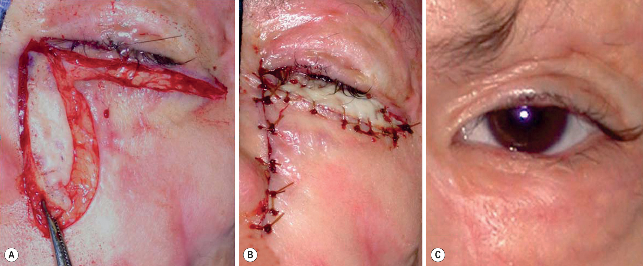 A three-part photograph sequence shows lower-lid reconstruction using a nasolabial flap with steps of flap dissection, suturing, and healed follow-up. The three-part photograph labeled A, B, and C. Part A shows the dissection of an island flap along the side of the nose, with its base preserved for blood supply. Part B shows the flap rotated and sutured into the lower eyelid defect to replace scarred skin. Part C shows the healed result with the eyelid in its normal position and smooth contour.