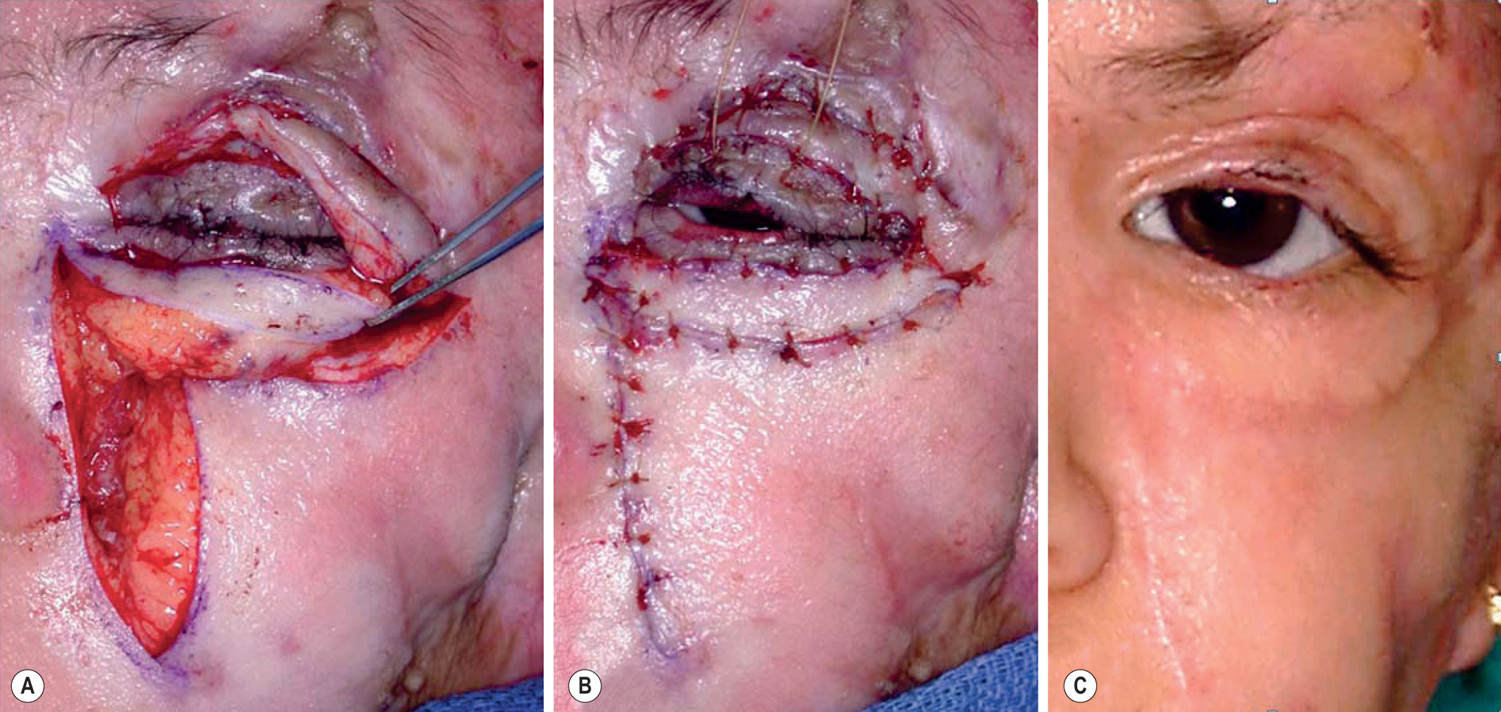 A three-part photograph sequence shows lower-lid reconstruction with myocutaneous and nasolabial flaps from flap elevation to healed follow-up. The three-part photograph labeled A, B, and C. Part A shows the elevation of a broad skin-and-muscle flap from the cheek area adjacent to the eyelid. Part B shows the flap inset and sutured along the lower eyelid margin to correct outward turning caused by scarring. Part C, taken after healing, shows a restored eyelid with proper closure and contour.
