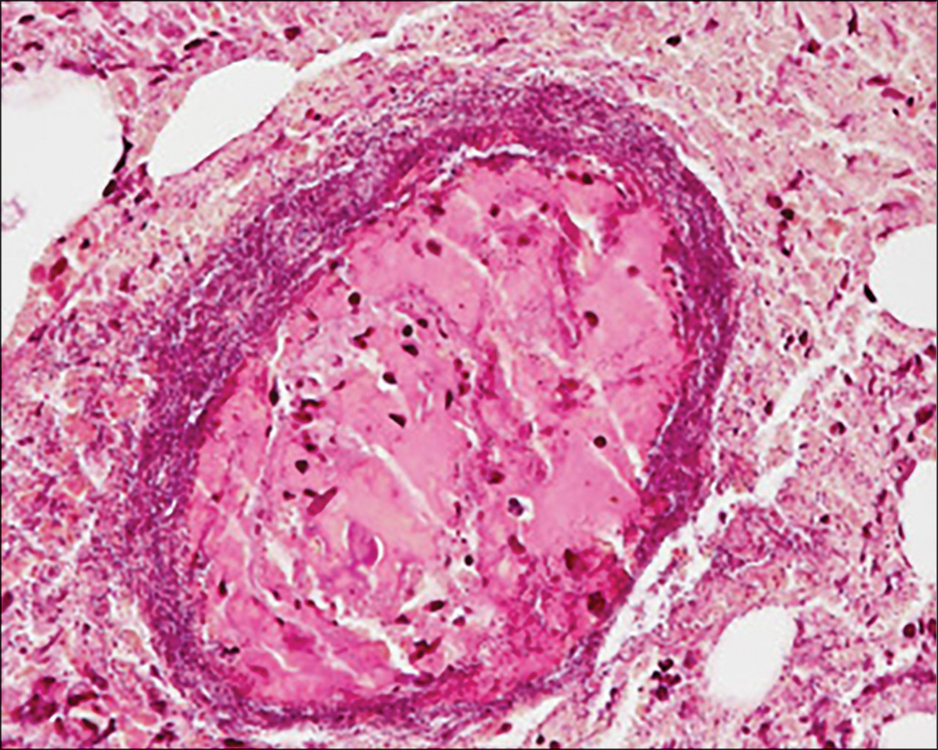 A micrograph shows numerous small rod-shaped bacteria scattered through connective tissue and densely grouped around a central vessel containing a fibrin plug, with intact surrounding stromal cells.