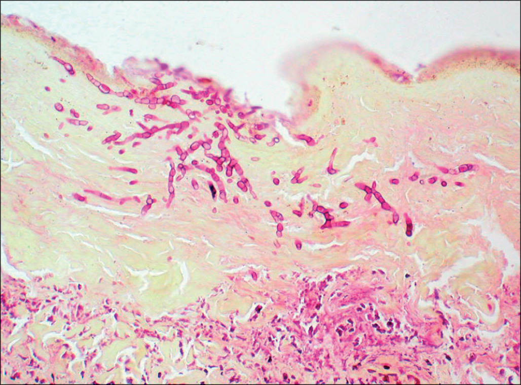 A micrograph shows thread-like fungal filaments extending through necrotic layers and approaching the border with preserved dermal tissue, forming interlacing strands across the damaged interface.