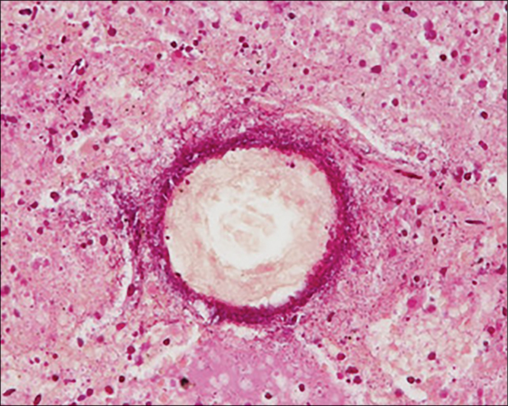 A micrograph shows a circular unstained region at the center of lung tissue devoid of nuclei, surrounded by a densely packed peripheral zone of congested capillaries and compressed alveolar walls.