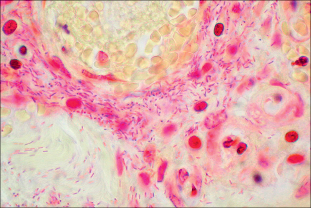 A micrograph shows many fine rod-shaped bacterial forms embedded in a small vessel wall and extending into adjacent tissue spaces, forming dense clusters with surrounding cellular debris at the edge.