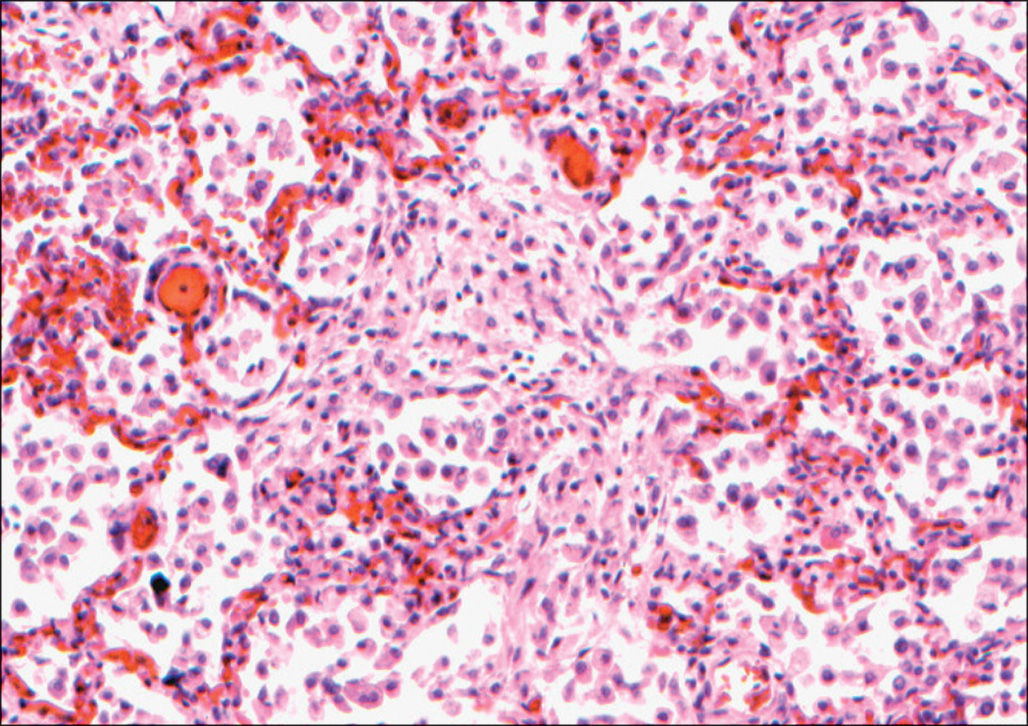 A micrograph shows elongated spindle-shaped cells distributed in alveolar spaces and fibrous tissue, with nuclei aligned in parallel rows and fine intercellular strands extending across the field.