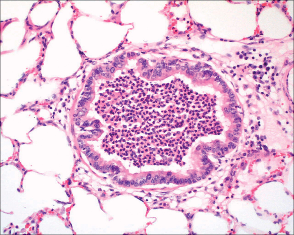 A micrograph shows a small bronchiole lumen filled with densely packed inflammatory cells forming a solid cluster, partially obstructing the airway and extending toward adjacent alveoli.