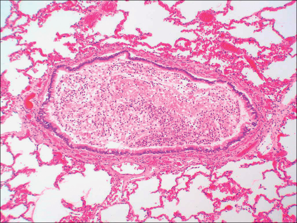 A micrograph shows a bronchiole lumen almost occluded by dense fibrinous and cellular material forming irregular strands, with preserved alveolar spaces seen around the obstructed passage.