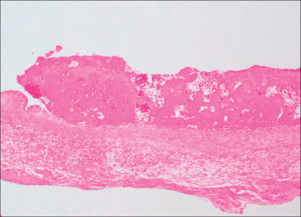 A micrograph shows a cardiac valve surface covered by a thick fibrin deposit forming irregular layered bands, with underlying tissue intact and no visible bacterial colonies.