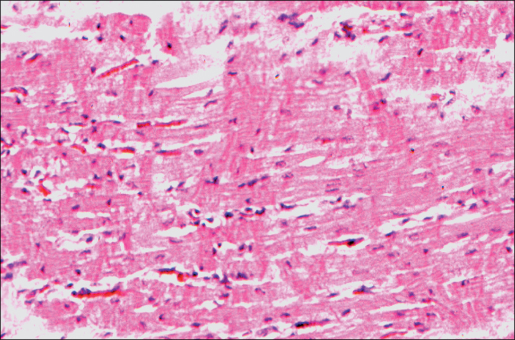 A micrograph shows parallel bands of contracted cardiac muscle fibers with dark linear contraction marks across the fibers, forming alternating light and dense zones through the myocardium.