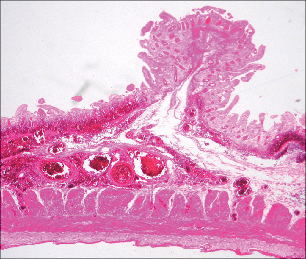 A low-power micrograph shows intestinal mucosa with a necrotic, folded surface lacking nuclei, contrasting with intact deeper layers that display normal structure and submucosal hemorrhage.