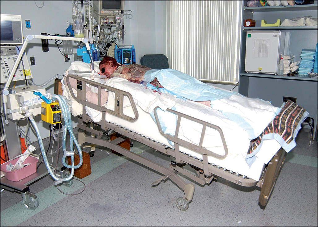 A photograph of a patient is lying prone on a hospital bed with skin grafts on the backside.