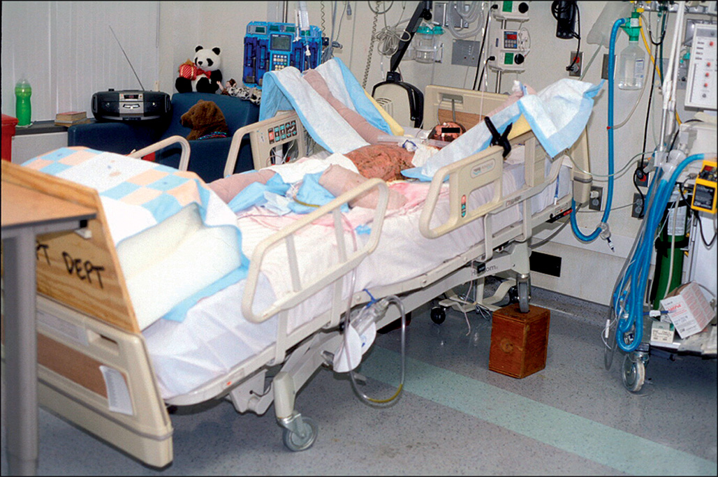 A photograph of a patient lying on a hospital bed elevated with wooden blocks in a reverse Trendelenburg position, with the head of the bed raised 30 to 45 degrees.