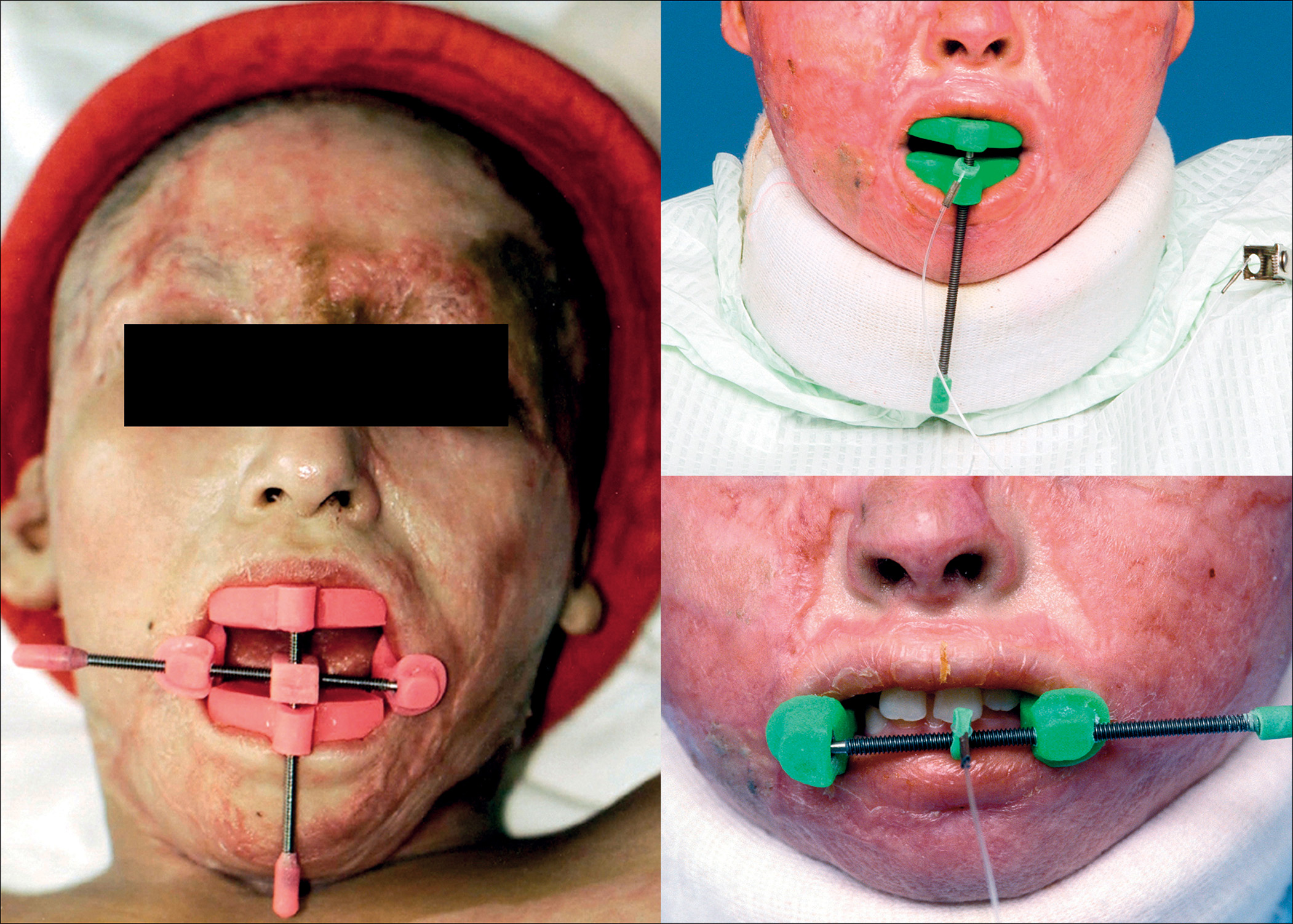 A set of three photographs showing a patient using horizontal, vertical, and circumferential devices that stretch and open the mouth in different directions to maintain oral mobility after burns.