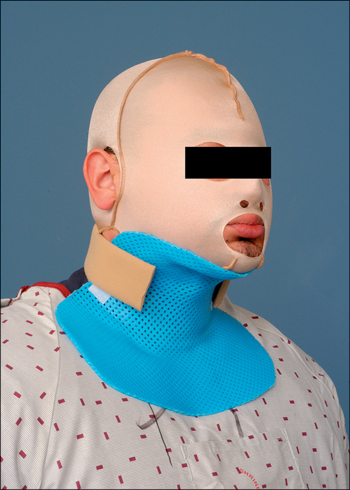 A photograph of a patient wearing a custom-molded, anterior neck conformer that covers the neck and lower face.