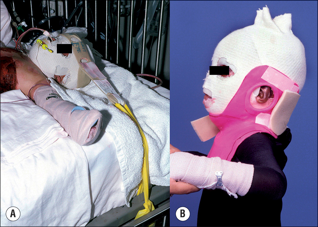 A two-part photograph labeled A and B. Part A shows a headrest and straps connected to an adjustable frame, and Part B shows a lateral neck splint covering the entire neck and backside of the head.