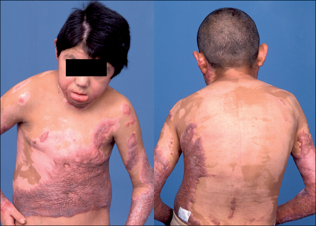 A set of front and back photographs of a child with severe burns. The photographs show extensive scarring and burns on the left chest, abdomen, and lateral trunk. The left side photograph with a front view shows chest and shoulder unevenness, and also spinal curvature. The right side photograph with a back view shows a curved spine and an asymmetrical posture.