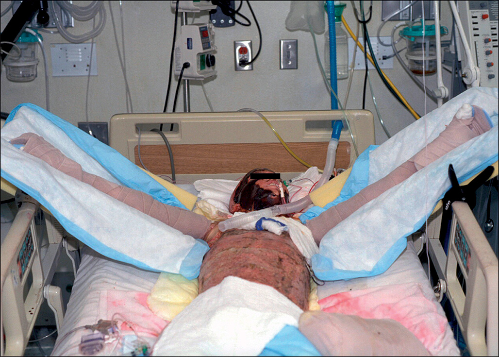 A photograph of a patient lying supine with the head elevated, arms positioned in large foam arm troughs to hold the shoulders at 90 degrees, maintaining proper shoulder alignment.