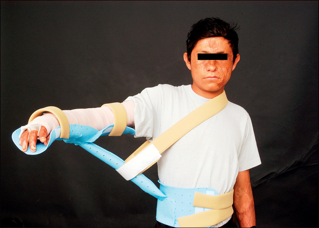 A photograph of a person wearing a three-piece airplane splint on their arm to secure a wound dressing while maintaining shoulder abduction.