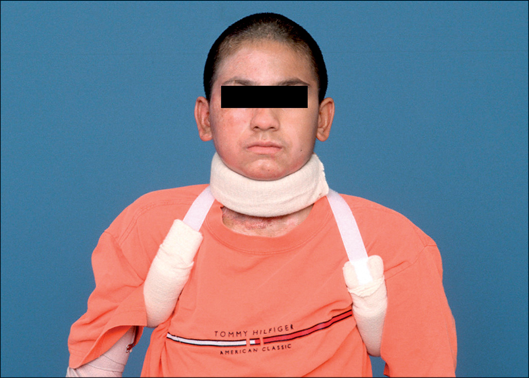 A photograph of a patient wearing a figure-of-eight axillary wrap that stretches the armpit skin while allowing elbow movement.