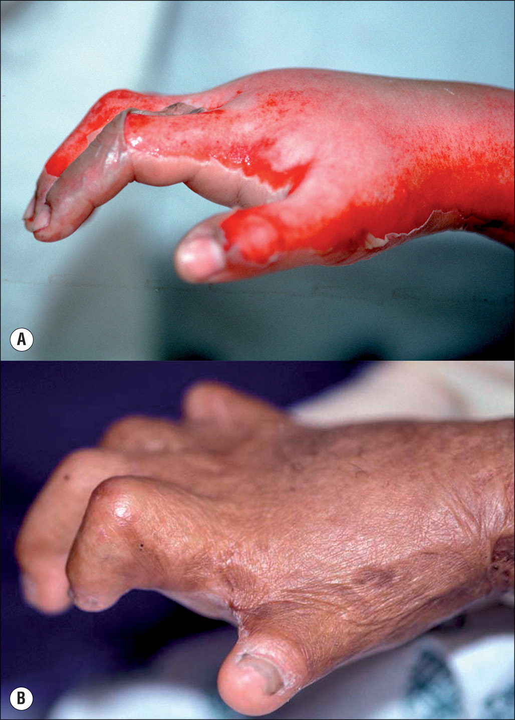 A two-part photograph labeled A and B shows a hand with a deep burn, while the same hand shows scarring and claw-like deformity developed after a prolonged period. The two photographs reflect the changes in the hand after a severe burn injury. The top photograph, labeled A, shows The Hand red, swollen, with a full-thickness burn on the fingertips and partly bent because of swelling. The bottom photograph labeled B shows the area as darker and scarred with claw-like posters, wear fingers are band two 2 tight contracted skin and tissue formed during healing.