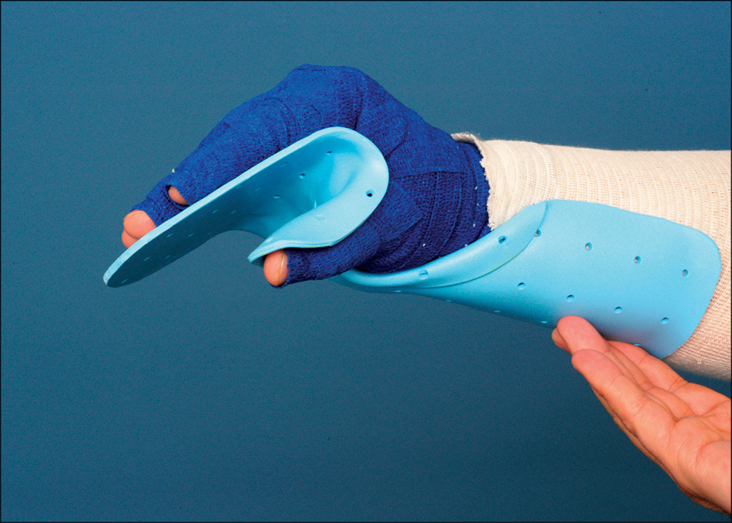 A photograph of a hand fitted with an intrinsic plus (anti-deformity) splint, covering the dorsal side, holding fingers and thumb in a safe position.