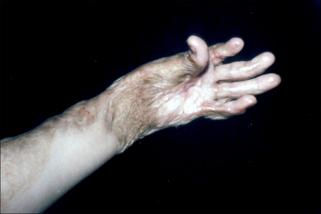 A photograph showing a hand in a cupped palm deformity, the fingers are slightly bent and cannot extend fully, with the thumb curled inwards. Burn marks appear on the wrist and the nearby area.
