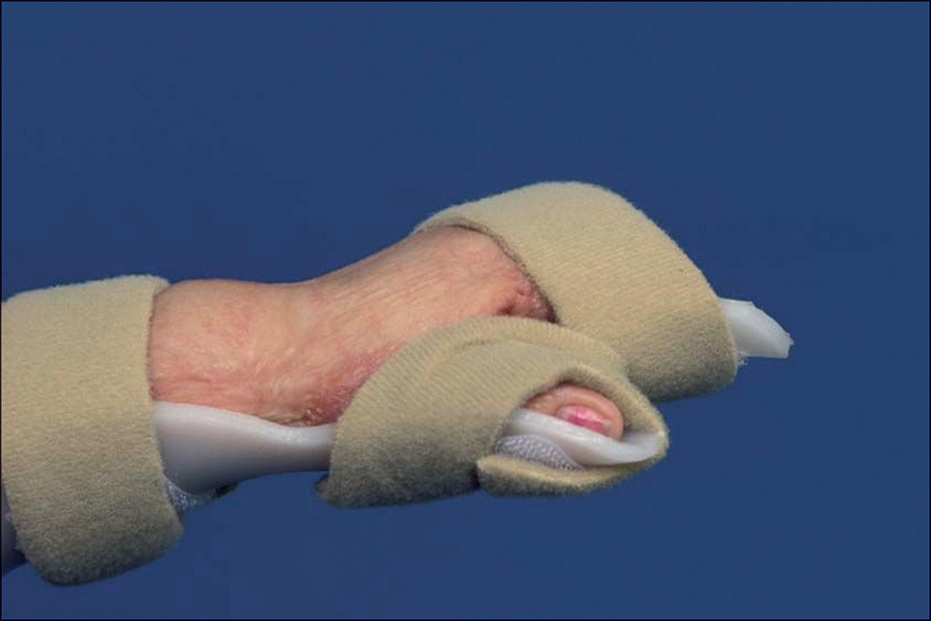 A photograph of a hand with a palmar extension splint or orthosis covering the palm and wrist, keeping the hand and fingers extended to stretch the skin.