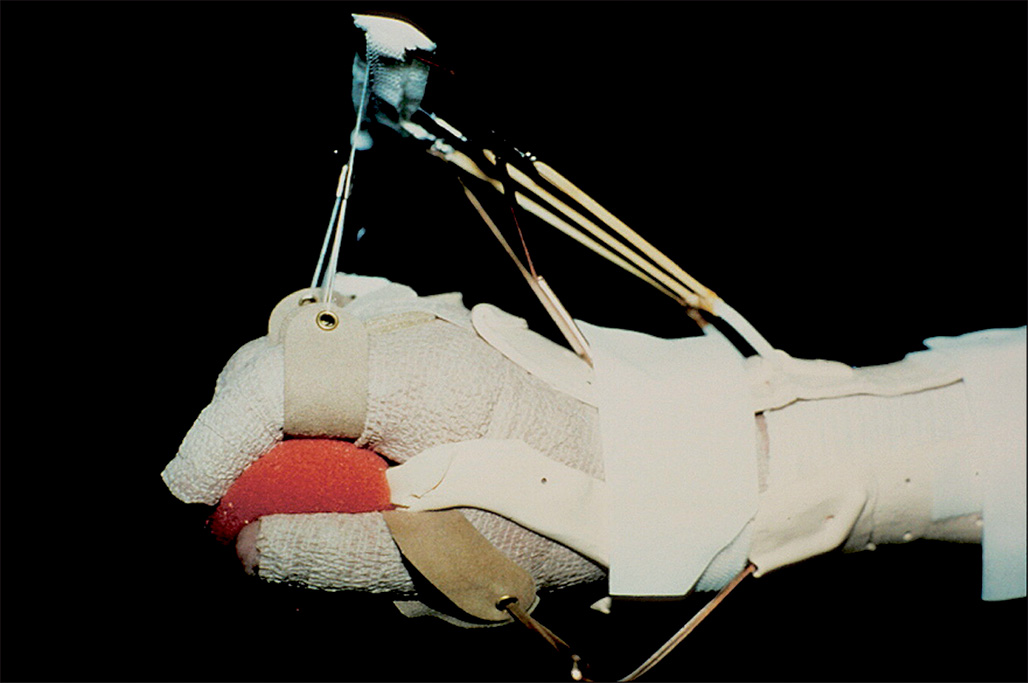 A photograph of a dynamic metacarpal extension splint on a hand, with spring-loaded or adjustable components holding the fingers in extension to promote functional hand use.