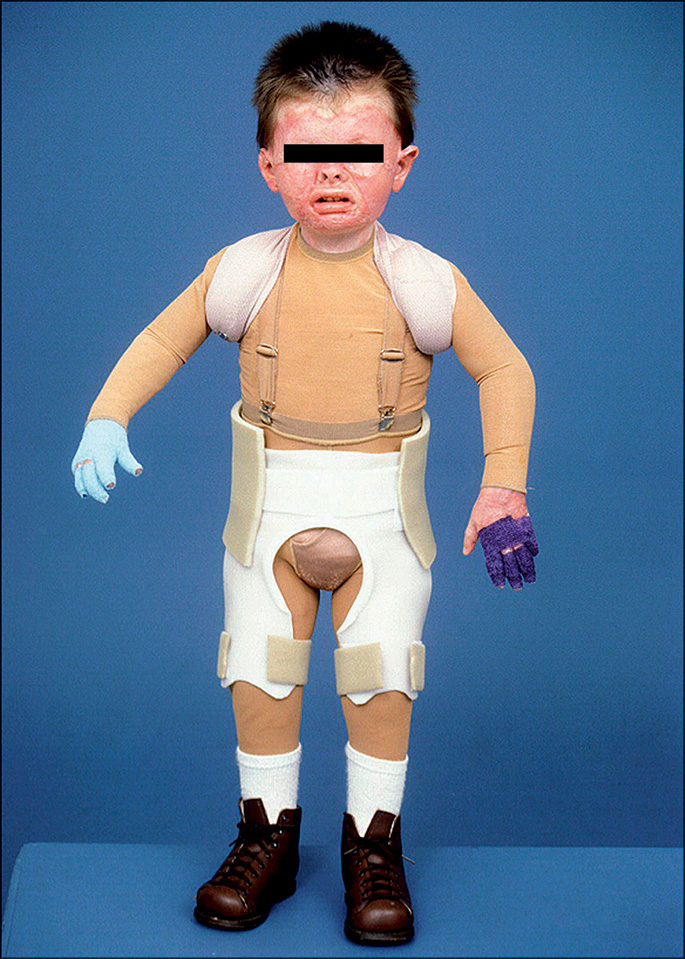 A photograph of a child with an anterior hip spica splint, extending from the lower abdomen to mid-thighs, with hips held in full extension and slight abduction, secured with straps or fasteners.