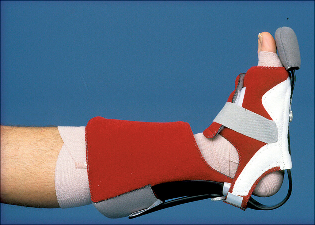 A photograph showing a Thera Podus splint supporting a patient’s foot in a neutral position, keeping the heel elevated and the ankle aligned.