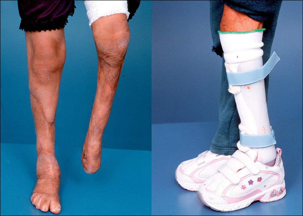 A set of photographs showing custom ankle-foot orthoses made with foam and silicone materials for patients with lower limb deformities or scarring. The set of photographs shows a close-up of a patient’s bare legs on the left and the one wearing a custom orthotic device on the right. The one on the left displays a splint made of stiff material with foam padding, and the other on the right shows a boot-type orthosis used to maximize range of motion.