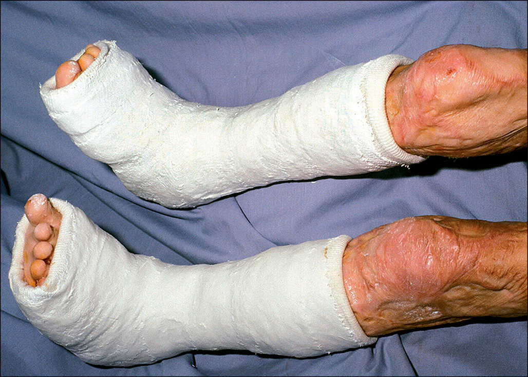 A photograph showing a patient’s foot and ankle wrapped in plaster casts with soft padding, providing a gentle stretch.