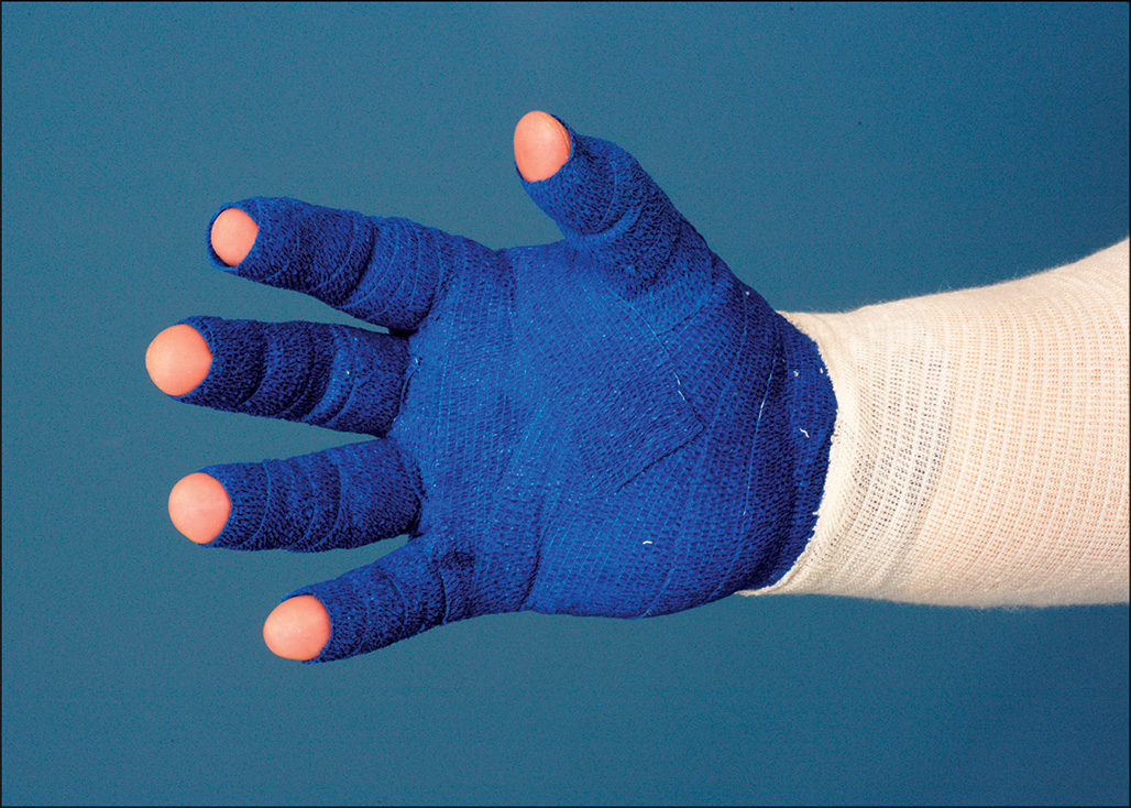 A photograph showing a patient’s hand and forearm wrapped with a Coban wrap that fits snugly around the skin.
