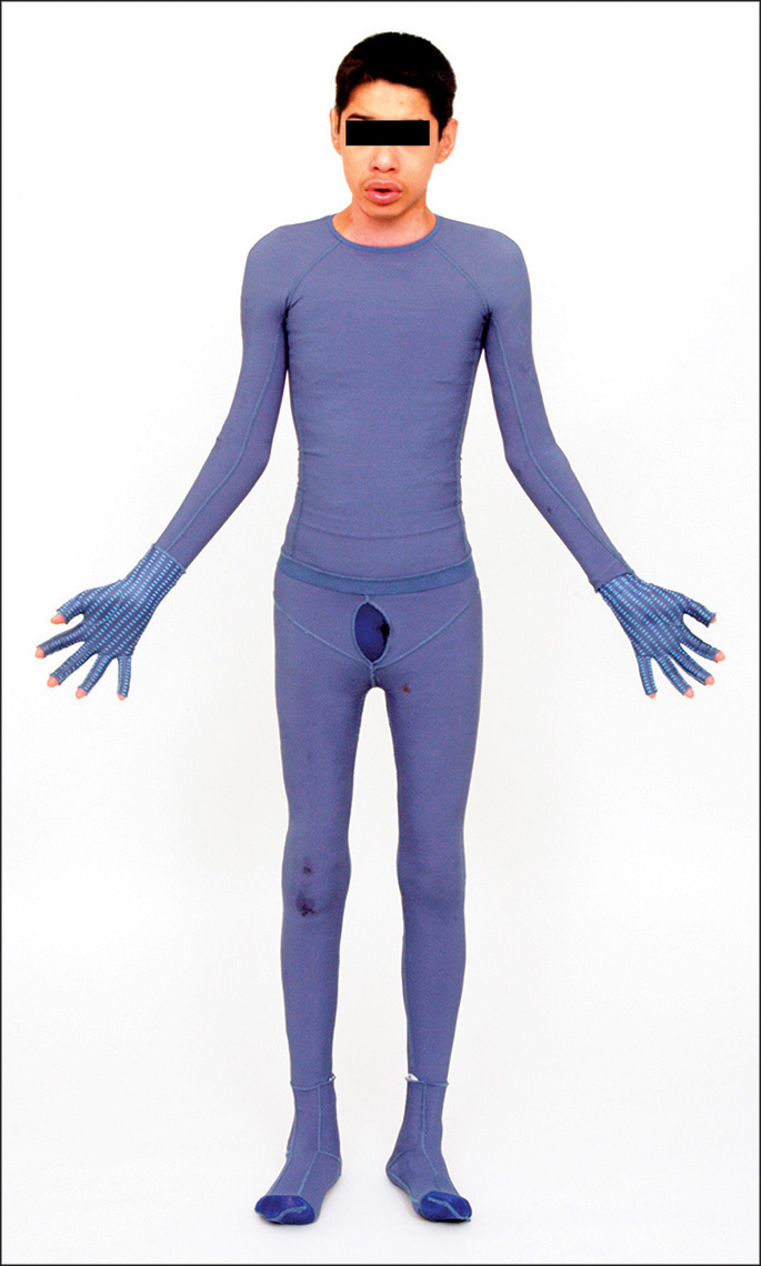 A photograph showing a full-body custom-made compression garment covering the patient’s entire body, including arms and legs.