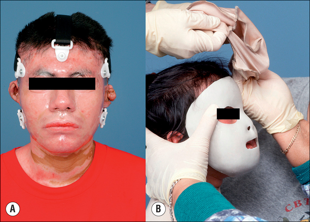 A set of photographs showing patients wearing transparent Uvex face masks and silicone elastomer pressure masks used to control facial scarring. The photographs show patients using two types of facial pressure masks for burn rehabilitation. The photograph on the left shows the patient wearing a clear plastic Uvex face mask secured with straps, while the one in the right photograph shows a child wearing a silicone elastomer mask contoured to facial features.