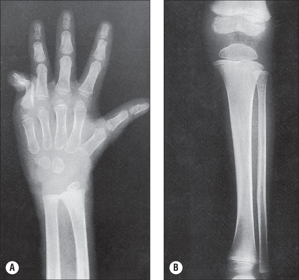 Two anteroposterior radiographs of the left hand and forearm shows coarse trabecular pattern and marked osteopenia. Part A shows an top view radiograph of the left hand and wrist. The phalanges, metacarpals, and carpal bones are visible. The trabecular pattern is coarse and there is marked reduction in bone density. No fractures are seen. The upper half of the fifth finger appears dislocated outward. The alignment of the other bones is maintained. Joint spaces between the phalanges, metacarpals, and carpals are preserved and appear normal. Part B shows a radiograph of the left forearm including the tibia and fibula. The cortical margins are intact and there is mild increase in radiolucency of the bones. The radius and ulna are aligned properly and run parallel. No fractures or dislocations are noted. Joint spacing at the elbow and wrist appears normal.