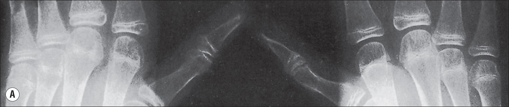 Four radiographs, A to D, indicate different stages of osteoporosis. Radiograph A shows an anteroposterior view of both hands with clearly visible metacarpal bones, proximal, middle, and distal phalanges, and interphalangeal and metacarpophalangeal joints. The bone contours are smooth, and the joint spaces are well defined. There is a heavy increase in radiolucency in the thumb and fingers of the right hand. Radiograph B shows a posteroanterior view of both hands with metacarpal bones and phalanges clearly outlined. The joint spaces are visible. The bone margins are distinct, and the alignment of the digits is maintained. There is a little increase in radiolucency of the digits. Radiograph C shows an A P view of the distal forearms, including the radius and ulna. The distal epiphyses are visible. The wrist joints are clearly defined, and the bones are aligned properly. There is a heavy persistance of radiolucency near the joints. Radiograph D shows a lateral view of the distal forearm with the radius and ulna in profile. The distal growth plates are closed. The contours of the bones are smooth, and the wrist joint is visible. There is a heavy persistance of radiolucency starting the joints and above them.
