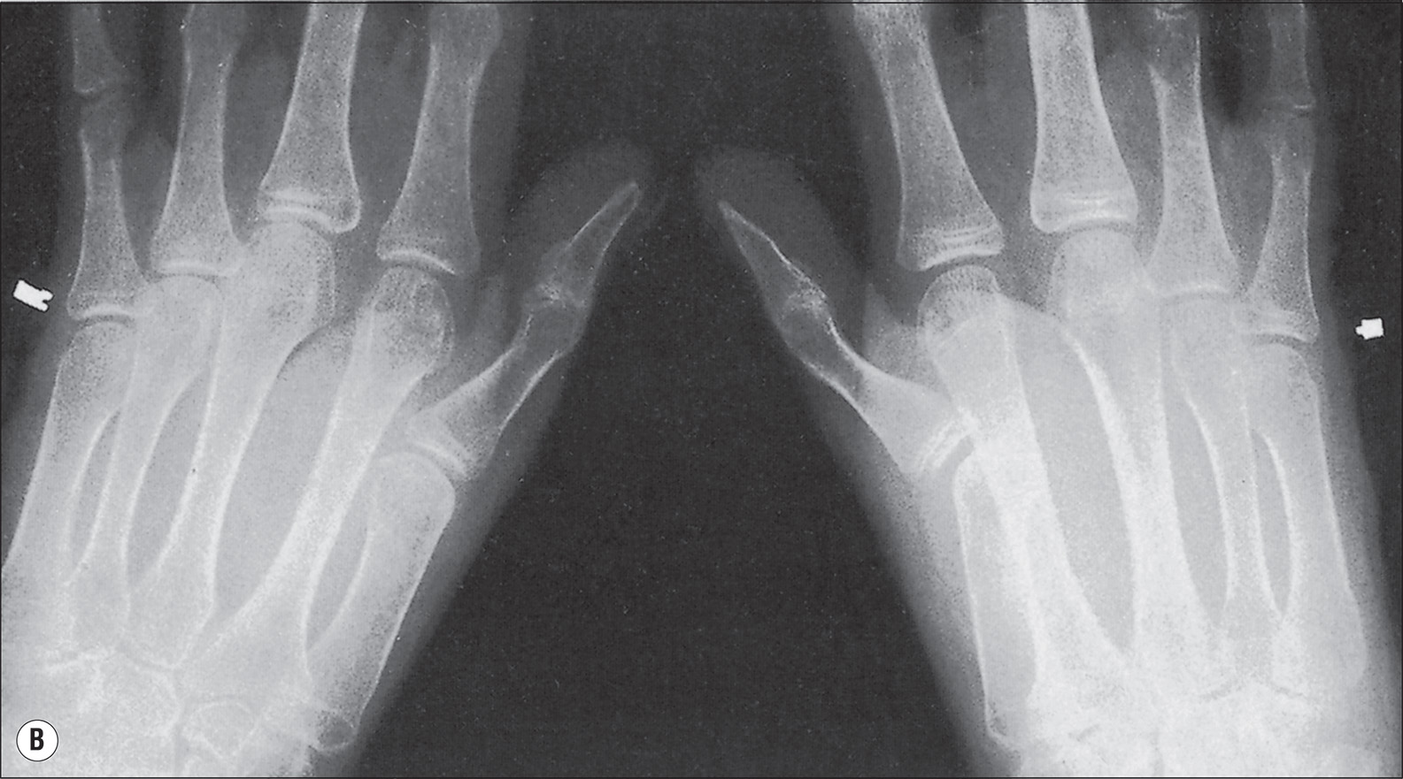Four radiographs, A to D, indicate different stages of osteoporosis. Radiograph A shows an anteroposterior view of both hands with clearly visible metacarpal bones, proximal, middle, and distal phalanges, and interphalangeal and metacarpophalangeal joints. The bone contours are smooth, and the joint spaces are well defined. There is a heavy increase in radiolucency in the thumb and fingers of the right hand. Radiograph B shows a posteroanterior view of both hands with metacarpal bones and phalanges clearly outlined. The joint spaces are visible. The bone margins are distinct, and the alignment of the digits is maintained. There is a little increase in radiolucency of the digits. Radiograph C shows an A P view of the distal forearms, including the radius and ulna. The distal epiphyses are visible. The wrist joints are clearly defined, and the bones are aligned properly. There is a heavy persistance of radiolucency near the joints. Radiograph D shows a lateral view of the distal forearm with the radius and ulna in profile. The distal growth plates are closed. The contours of the bones are smooth, and the wrist joint is visible. There is a heavy persistance of radiolucency starting the joints and above them.