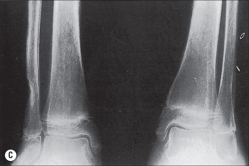 Four radiographs, A to D, indicate different stages of osteoporosis. Radiograph A shows an anteroposterior view of both hands with clearly visible metacarpal bones, proximal, middle, and distal phalanges, and interphalangeal and metacarpophalangeal joints. The bone contours are smooth, and the joint spaces are well defined. There is a heavy increase in radiolucency in the thumb and fingers of the right hand. Radiograph B shows a posteroanterior view of both hands with metacarpal bones and phalanges clearly outlined. The joint spaces are visible. The bone margins are distinct, and the alignment of the digits is maintained. There is a little increase in radiolucency of the digits. Radiograph C shows an A P view of the distal forearms, including the radius and ulna. The distal epiphyses are visible. The wrist joints are clearly defined, and the bones are aligned properly. There is a heavy persistance of radiolucency near the joints. Radiograph D shows a lateral view of the distal forearm with the radius and ulna in profile. The distal growth plates are closed. The contours of the bones are smooth, and the wrist joint is visible. There is a heavy persistance of radiolucency starting the joints and above them.