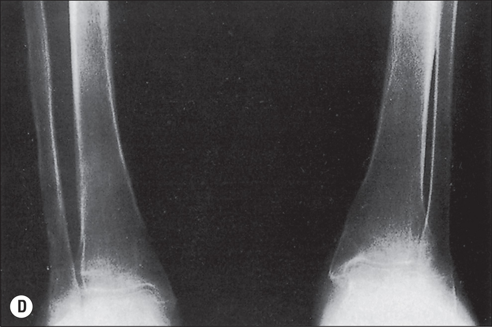 Four radiographs, A to D, indicate different stages of osteoporosis. Radiograph A shows an anteroposterior view of both hands with clearly visible metacarpal bones, proximal, middle, and distal phalanges, and interphalangeal and metacarpophalangeal joints. The bone contours are smooth, and the joint spaces are well defined. There is a heavy increase in radiolucency in the thumb and fingers of the right hand. Radiograph B shows a posteroanterior view of both hands with metacarpal bones and phalanges clearly outlined. The joint spaces are visible. The bone margins are distinct, and the alignment of the digits is maintained. There is a little increase in radiolucency of the digits. Radiograph C shows an A P view of the distal forearms, including the radius and ulna. The distal epiphyses are visible. The wrist joints are clearly defined, and the bones are aligned properly. There is a heavy persistance of radiolucency near the joints. Radiograph D shows a lateral view of the distal forearm with the radius and ulna in profile. The distal growth plates are closed. The contours of the bones are smooth, and the wrist joint is visible. There is a heavy persistance of radiolucency starting the joints and above them.