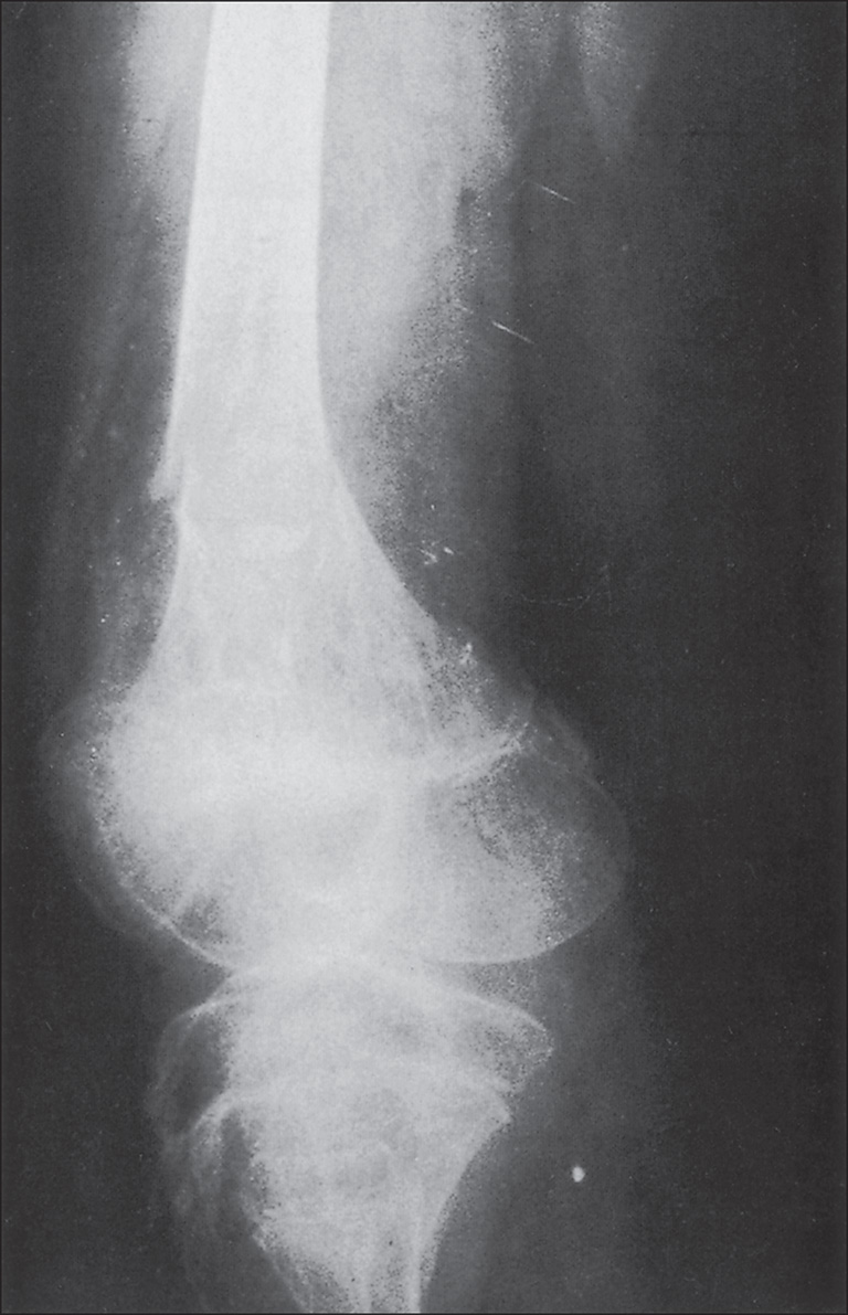 An anteroposterior radiograph of the femur with the proximal and distal segments clearly visible. The shaft of the femur appears elongated and the cortical margins are defined. The femoral head and neck are visible with smooth contours. The distal femur shows a rounded epiphyseal region and the joint space is outlined. There is a visible transverse lucency across the shaft indicating a break in continuity.