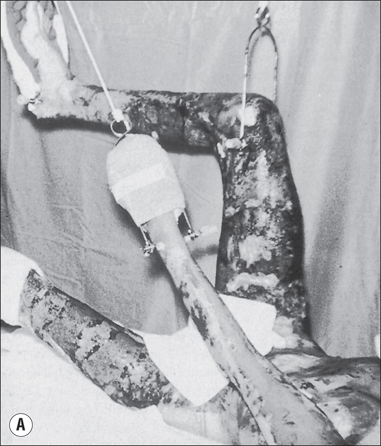 A clinical photograph of a leg, A, and two anteroposterior radiographs, B and C, of the humerus. Photo A shows a clinical setup with the patient lying supine on a hospital bed. The right lower extremity is elevated and suspended using a traction apparatus. The leg is wrapped in bandages and supported by a skeletal traction system with visible weights hanging from the end. The left leg is positioned flat on the bed and encased in a circular cast extending from below the knee to the ankle. The upper extremities are resting alongside the body. Part B shows a radiograph of the left humerus. The shaft of the humerus displays a transverse fracture line at mid-diaphysis. The cortical margins are interrupted, and the bone ends are slightly displaced. Part C shows a radiograph of the same humerus. The fracture site shows callus formation bridging the fracture line. The bone ends are aligned, and the cortical margins are becoming continuous. The density of the callus is heterogeneous, and the soft tissues remain unchanged.