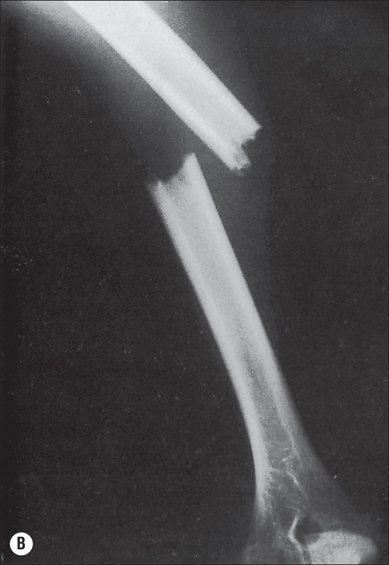 A clinical photograph of a leg, A, and two anteroposterior radiographs, B and C, of the humerus. Photo A shows a clinical setup with the patient lying supine on a hospital bed. The right lower extremity is elevated and suspended using a traction apparatus. The leg is wrapped in bandages and supported by a skeletal traction system with visible weights hanging from the end. The left leg is positioned flat on the bed and encased in a circular cast extending from below the knee to the ankle. The upper extremities are resting alongside the body. Part B shows a radiograph of the left humerus. The shaft of the humerus displays a transverse fracture line at mid-diaphysis. The cortical margins are interrupted, and the bone ends are slightly displaced. Part C shows a radiograph of the same humerus. The fracture site shows callus formation bridging the fracture line. The bone ends are aligned, and the cortical margins are becoming continuous. The density of the callus is heterogeneous, and the soft tissues remain unchanged.