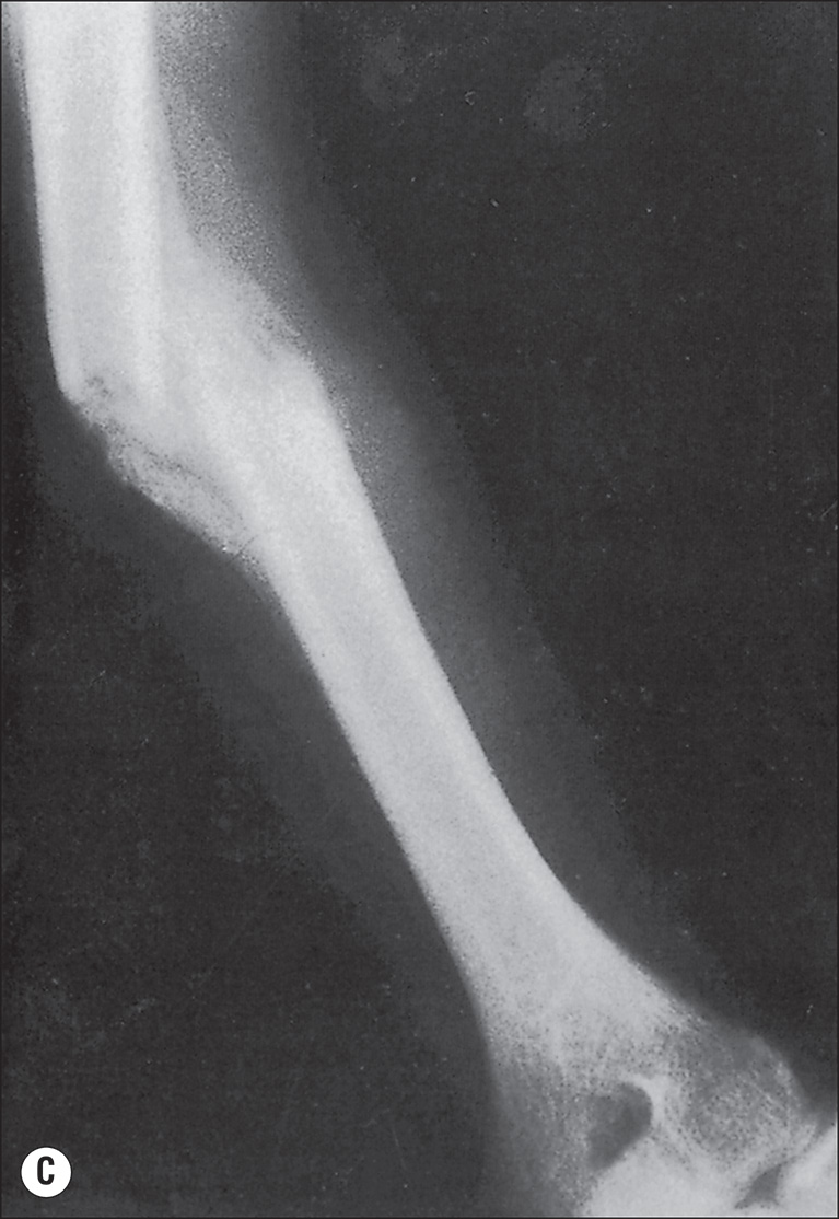 A clinical photograph of a leg, A, and two anteroposterior radiographs, B and C, of the humerus. Photo A shows a clinical setup with the patient lying supine on a hospital bed. The right lower extremity is elevated and suspended using a traction apparatus. The leg is wrapped in bandages and supported by a skeletal traction system with visible weights hanging from the end. The left leg is positioned flat on the bed and encased in a circular cast extending from below the knee to the ankle. The upper extremities are resting alongside the body. Part B shows a radiograph of the left humerus. The shaft of the humerus displays a transverse fracture line at mid-diaphysis. The cortical margins are interrupted, and the bone ends are slightly displaced. Part C shows a radiograph of the same humerus. The fracture site shows callus formation bridging the fracture line. The bone ends are aligned, and the cortical margins are becoming continuous. The density of the callus is heterogeneous, and the soft tissues remain unchanged.