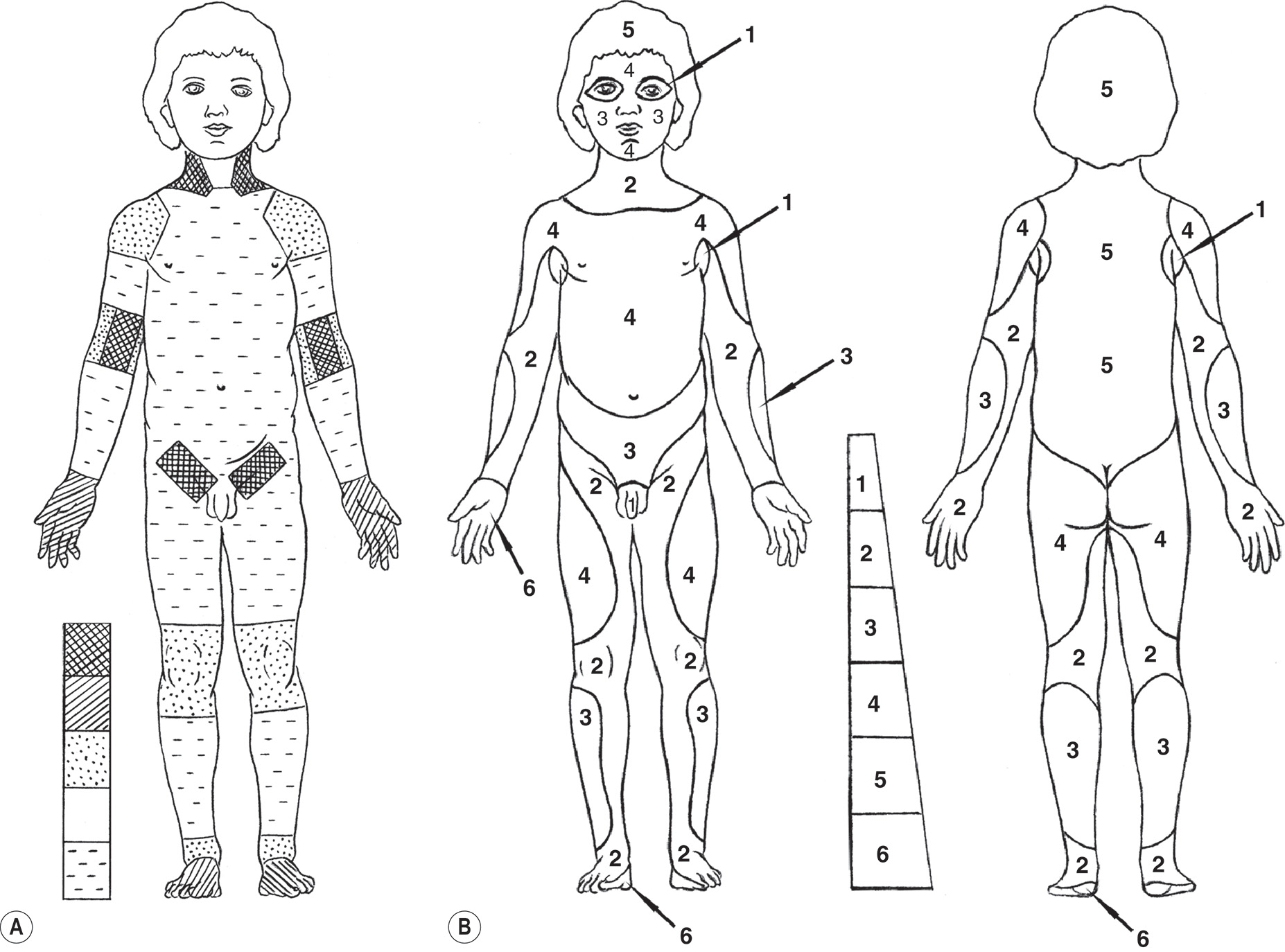 Three diagrams of a child’s body, front view labeled A and front and back outlines labeled B, showing marked areas for burn treatment planning. Diagram A shows various regions are filled with distinct patterns. A legend on the left side encloses each pattern. Diagram B includes the body divided into numbered sections, each corresponding to specific anatomical regions. A legend on the right side lists the numbers with increasing size of boxes from 1 to 6. Diagram A shows front view of a child with different shading patterns representing specific anatomical regions: A checkered pattern is located on the neck area (both front and back). Horizontal lines cover the upper torso, arms, and upper legs. Solid areas are marked on the elbows and knees. Dotted Pattern found on the lower torso, hands, and feet. Diagram B has numbered sections and includes front and back along with sides of hand within back view of a child with numbered regions indicating specific body parts. Number 1 is located on the forehead and shoulders. Number 2 is found on the upper arms, forearms, front and back of thighs, front and back of lower legs, and buttocks. Number 3 is positioned on the underarm areas (sides of the torso). Number 4 is located on the chest. Number 5 is placed at the top center of the head. Number 6 is found in the genital area.